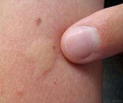 خارش و جای گزیدگی کک خارش و جای گزیدگی کک