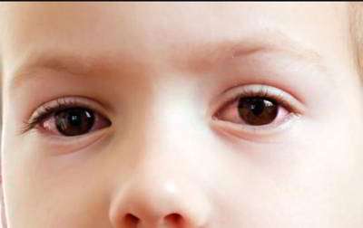 قرمزی چشم در کودکان و علائم آن قرمزی چشم در کودکان و علائم آن