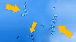 علت مگس پران چشم یا مگسک Floater چیست؟ علت مگس پران چشم یا مگسک Floater چیست؟